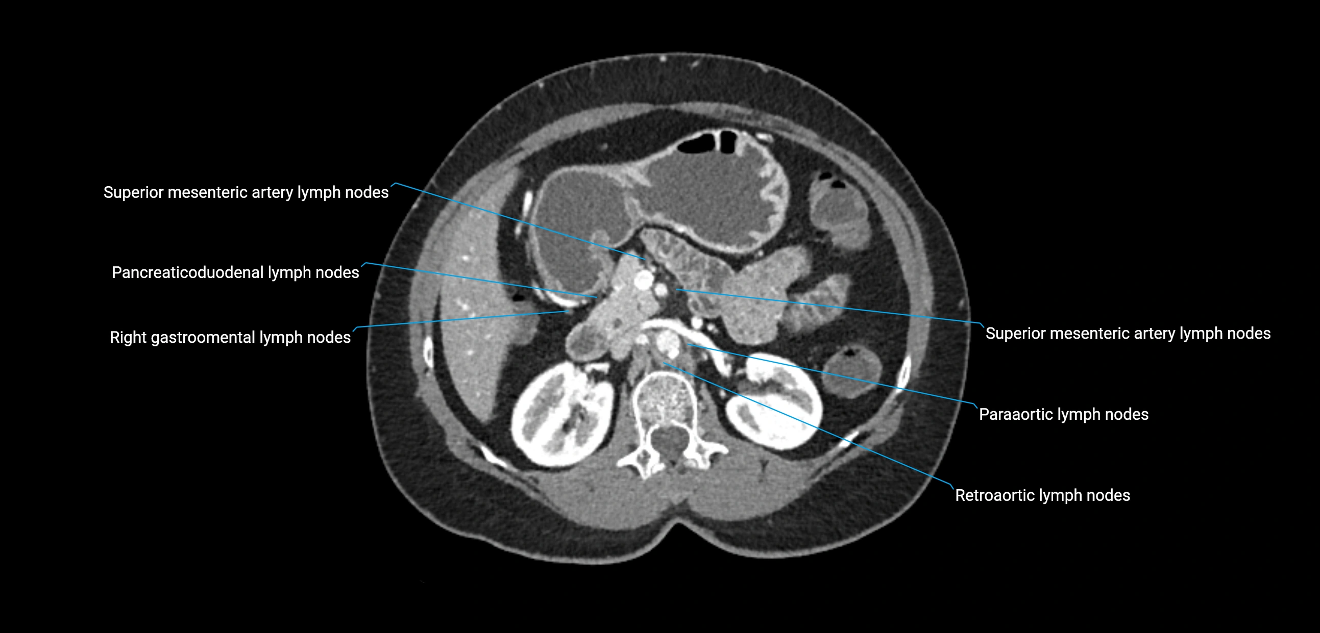 CT ct abdominal lymph nodes  axial cross sectional anatomy  enchanced radiology image -img-00002-00171.webp